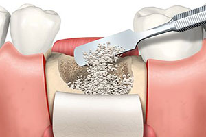 colorado-springs-bone-graft