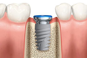 colorado-springs-dental-implants