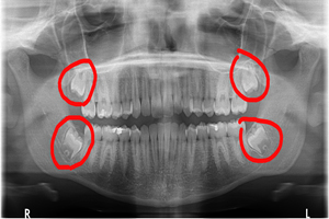 colorado-springs-wisdom-teeth-removal